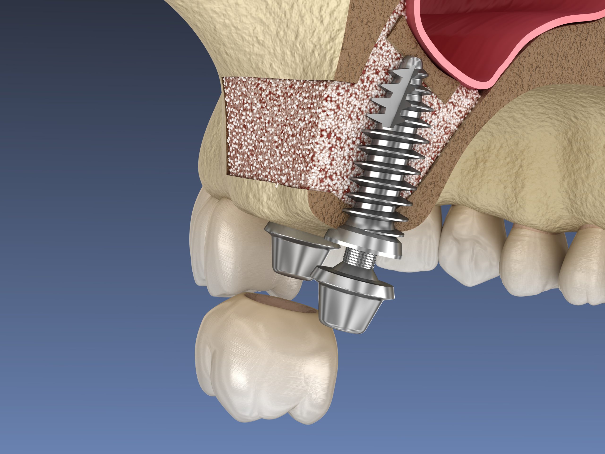 Dental crowns in a North York dentistry